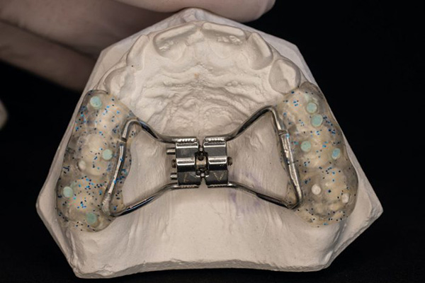 Hyrax Rapid Palatal Expander