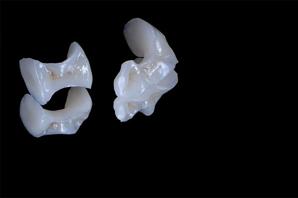 Zirconia Inlay / Onlay