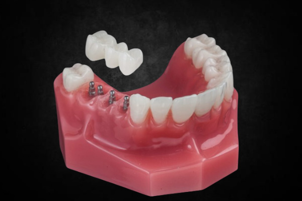 Implant Crown & Bridge