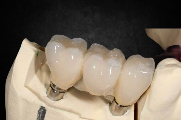 Implant Crown & Bridge