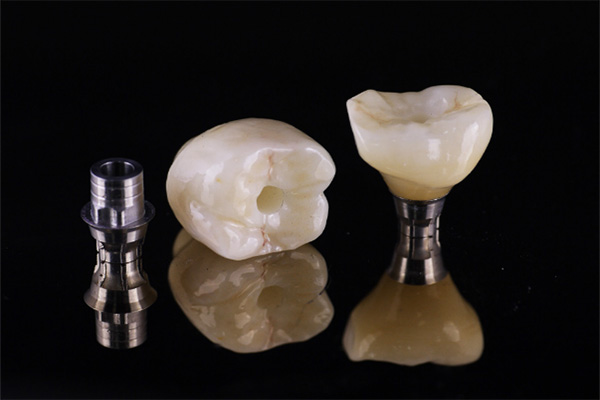 Implant Crown & Bridge